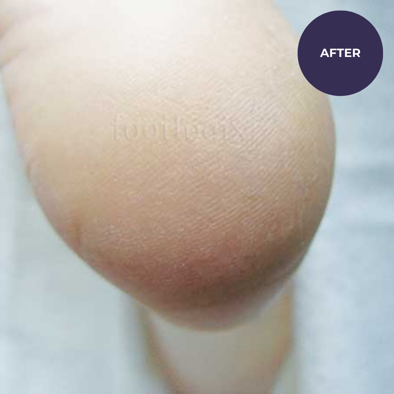 Footlogix Cracked Heel Formula (125ml)