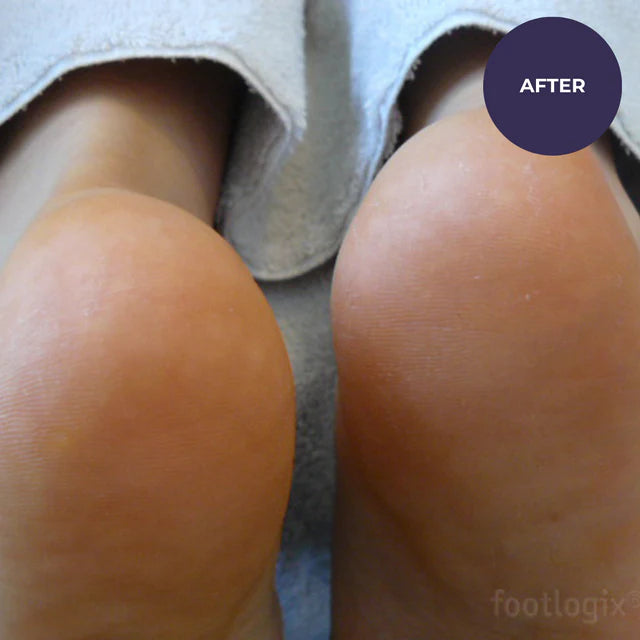 Footlogix Very Dry Skin Formula (125ml)